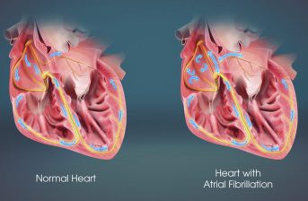 problemi fibrillazione atriale