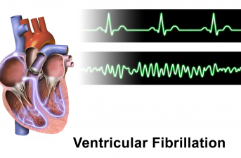 problematica fibrillazione ventricolare