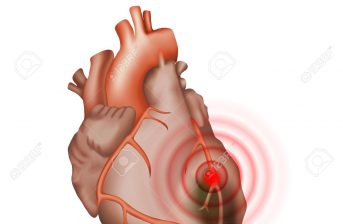 infarto miocardico