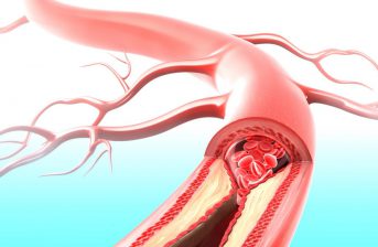 troppo colesterolo arterie conseguenze